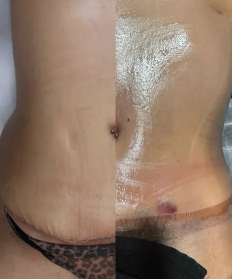 Drainage Lymphatique Paris Before After Post Op Bien Etre Drainage Lymphatique Paris Before After Post Op Bien Etre